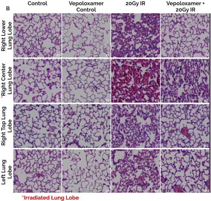 Acute Pneumonitis B