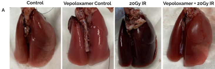 Acute Pneumonitis